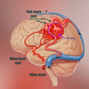 Dị dạng mạch máu não